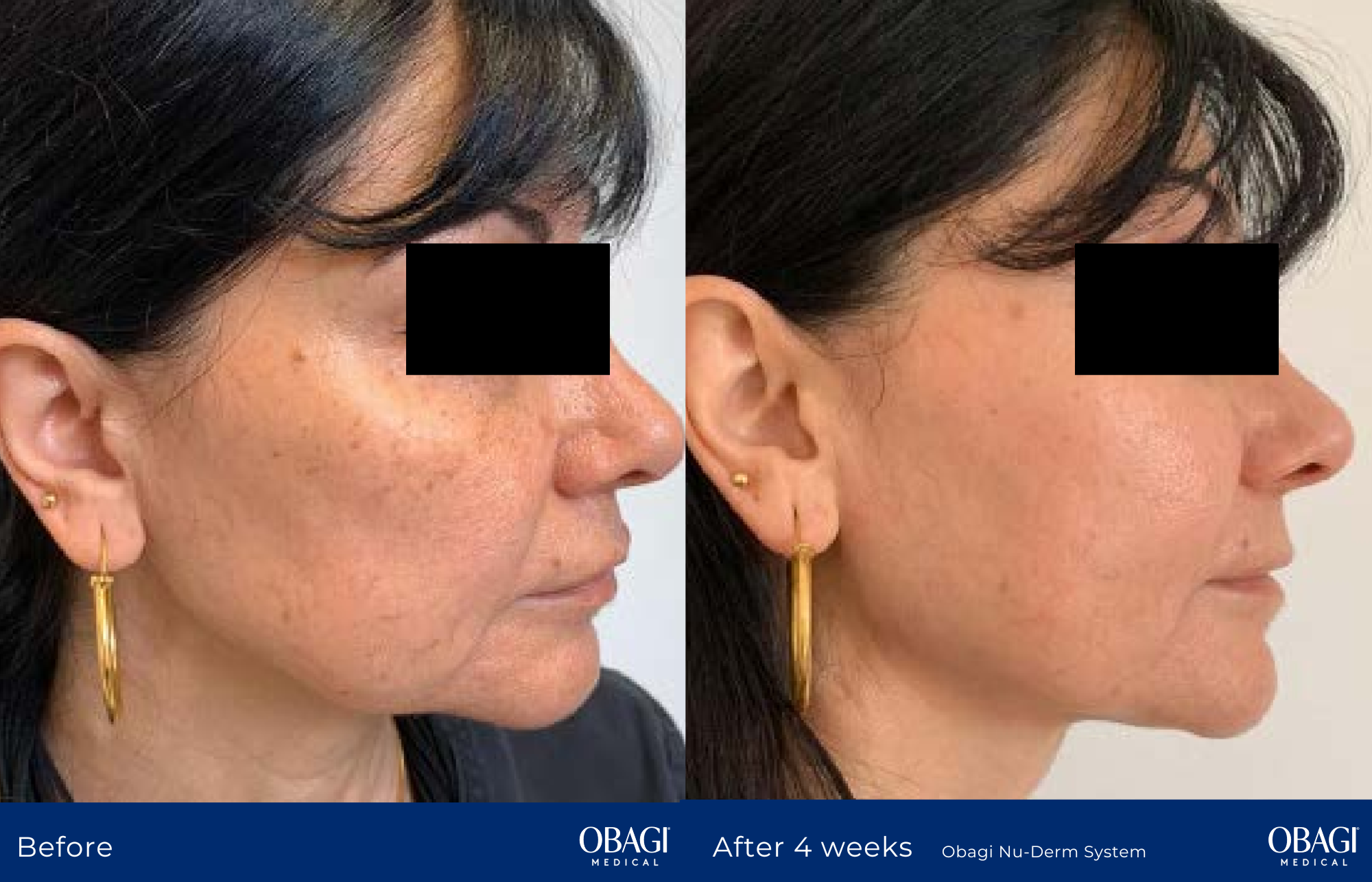 Hyperpigmentation Iamge 4