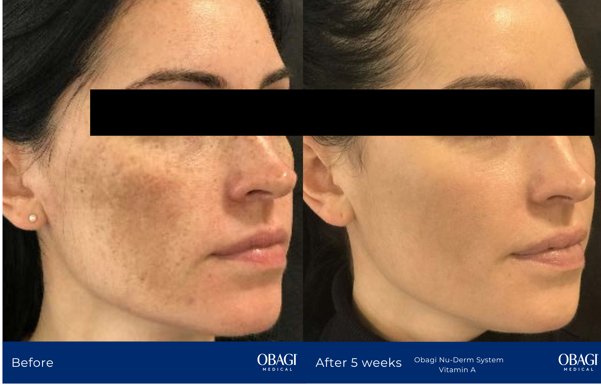 Hyperpigmentation_Image_1