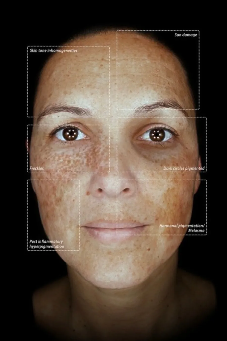 The Observ 520x at Thriyv Wellness and Aesthetics Manchester can be used to identify and treat signs of hyperpigmentation, including sun damage or sun spots.