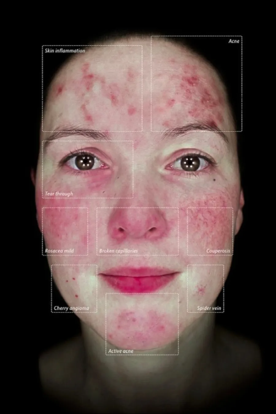 The Observ 520x at Thriyv Wellness and Aesthetics Manchester can be used to identify and treat vascularity and redness.