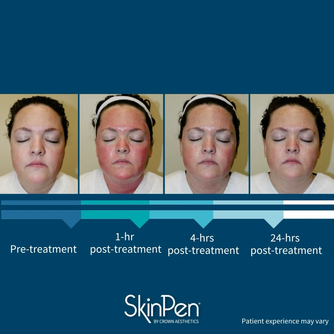 Thriyv offers microneedling in Manchester City Centre at our Wellness and Aesthetics hub.